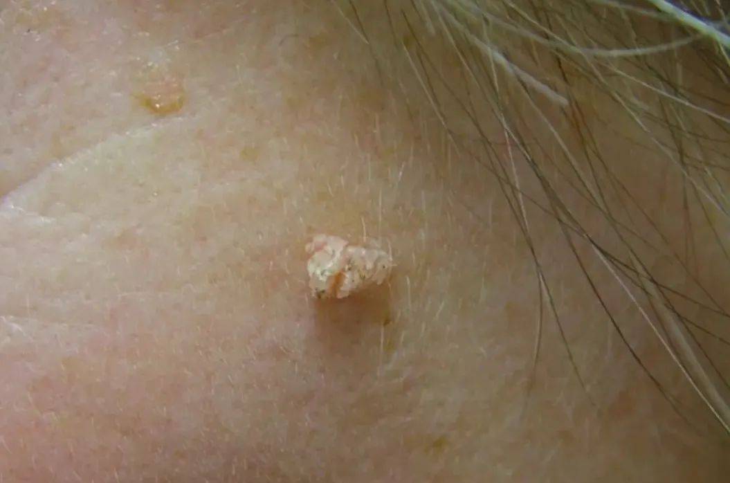 皇冠信用網在哪里开通_脖子上长出的小肉粒皇冠信用網在哪里开通，能揪吗？