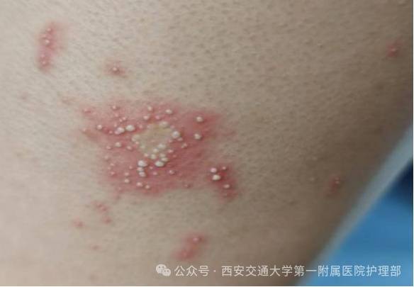 皇冠信用盘_西安多区发现隐翅虫？千万别拍皇冠信用盘！毒液堪比硫酸