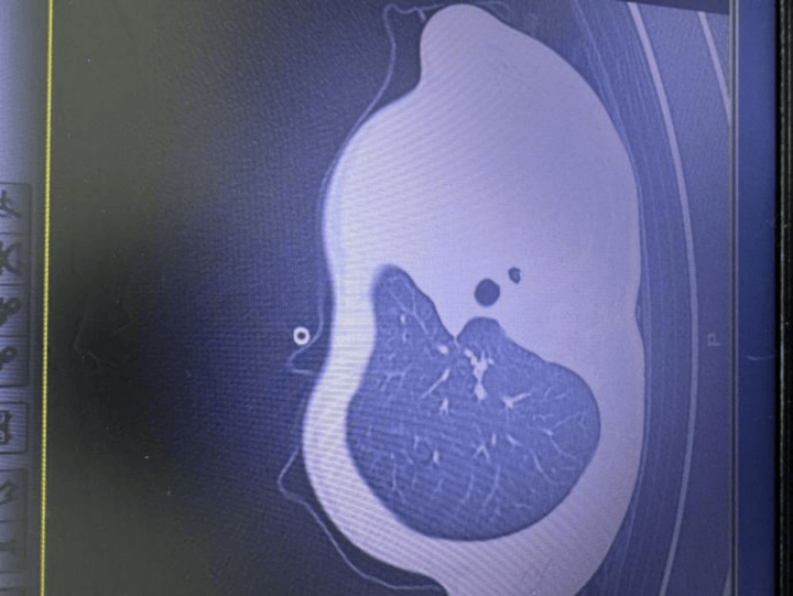 皇冠信用网正版_发热一天就病危皇冠信用网正版！11岁男孩肺里长出“死亡树杈”